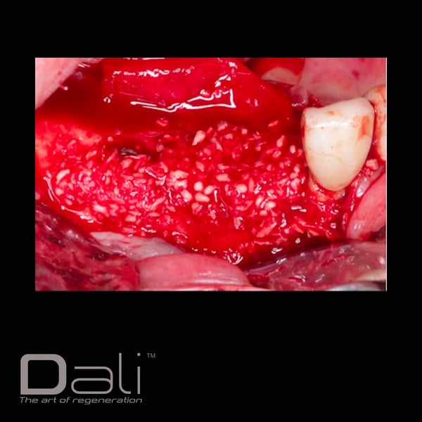 DALI Mineralized Cortical Cancellous Graft Case 2