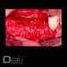 DALI Mineralized Cortical Cancellous Graft Case 2 thumbnail