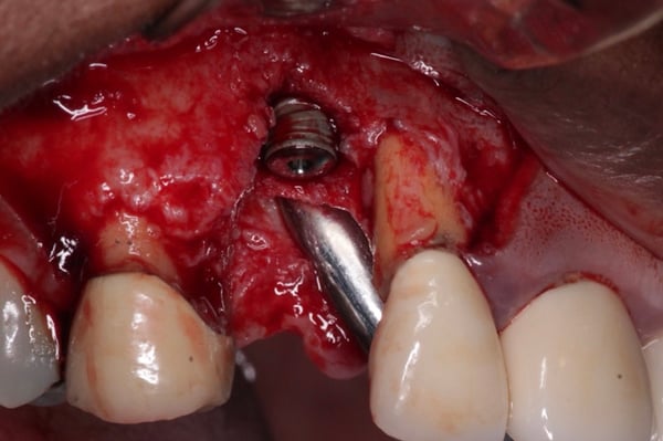DALI Flex Graft for Buccal Augmentation