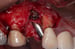DALI Flex Graft for Buccal Augmentation Implant Placement 1 thumbnail