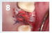 Osteogen Suture Guide 8 thumbnail