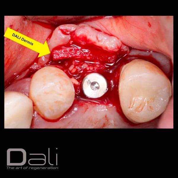 DALI Dermis Case