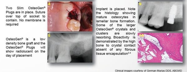 Osteogen Case 2