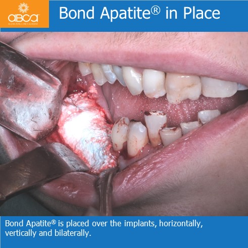 Bond Apatite in Place