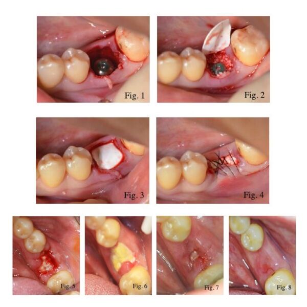 Cytoflex Textured Tefguard Case