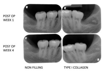 wound dressing study