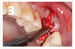 Osteogen Suture Guide 3 thumbnail