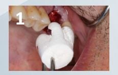 Osteogen Suture Guide 1