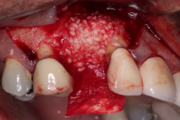 DALI Flex Graft for Buccal Augmentation Implant Placement 2