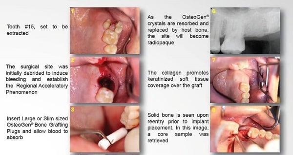 OsteoGen Bone Grafting Plug Case