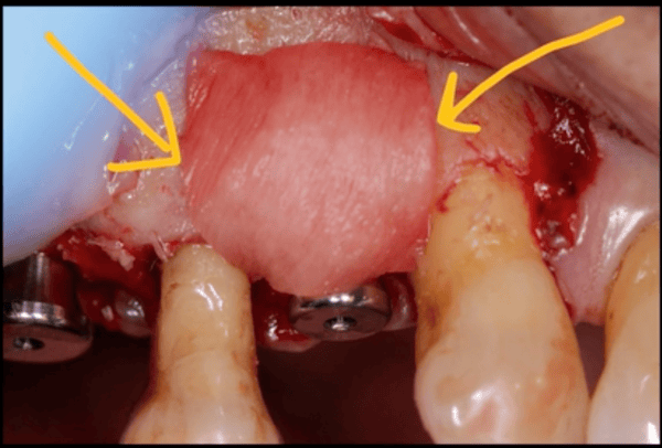 Membrane Adaptability: Using OsseoSeal for Buccal Contour Augmentation