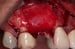 DALI Flex Graft for Buccal Augmentation Implant Placement 3 thumbnail