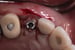DALI Flex Graft for Buccal Augmentation abutment 8 thumbnail