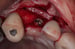 DALI Flex Graft for Buccal Augmentation placement 7 thumbnail