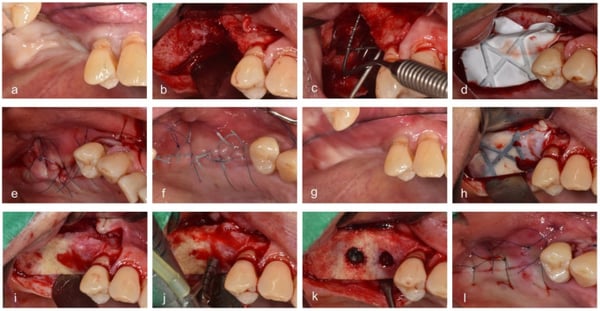 Microporous PTFE Membranes for Vertical Augmentation