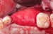 buccal flap was released 4 thumbnail