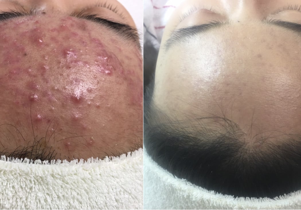Acne Treatment SF 1