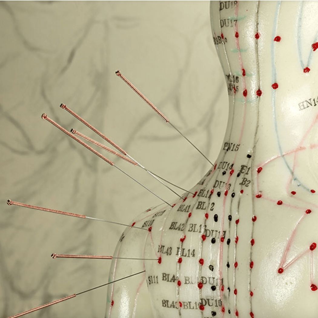 Community Acupuncture 1