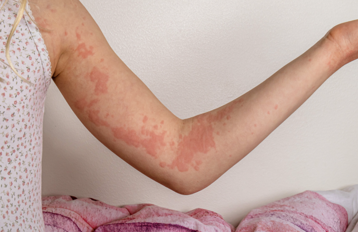 Rash