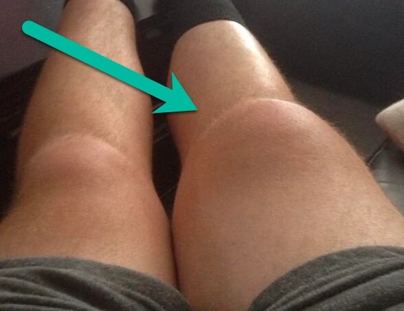 swollen knee