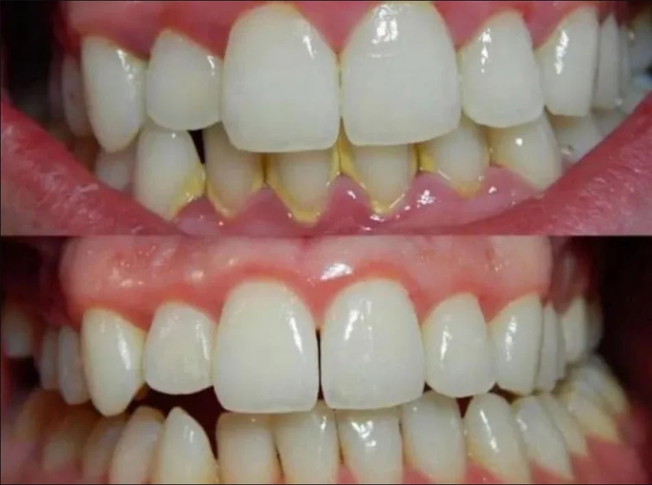 Denta vs others