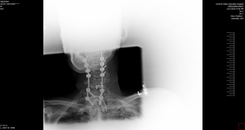 Medical image showing surgical pins in neck after surgery