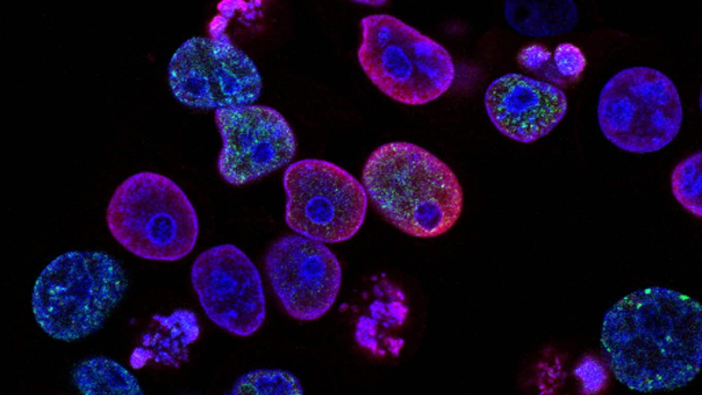 OncoBlast™-ctDNA in Muscle-Invasive Bladder Cancer: From Evidence to Everyday Practice thumbnail