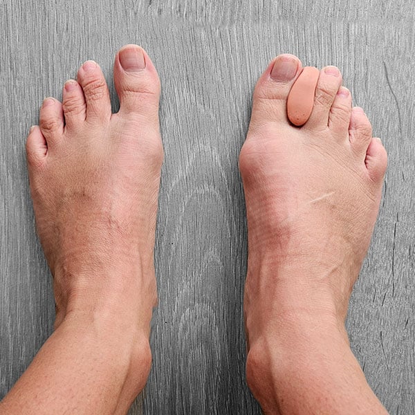 Hallux Valgus teenspreider helpt bij het voorkomen van erger.