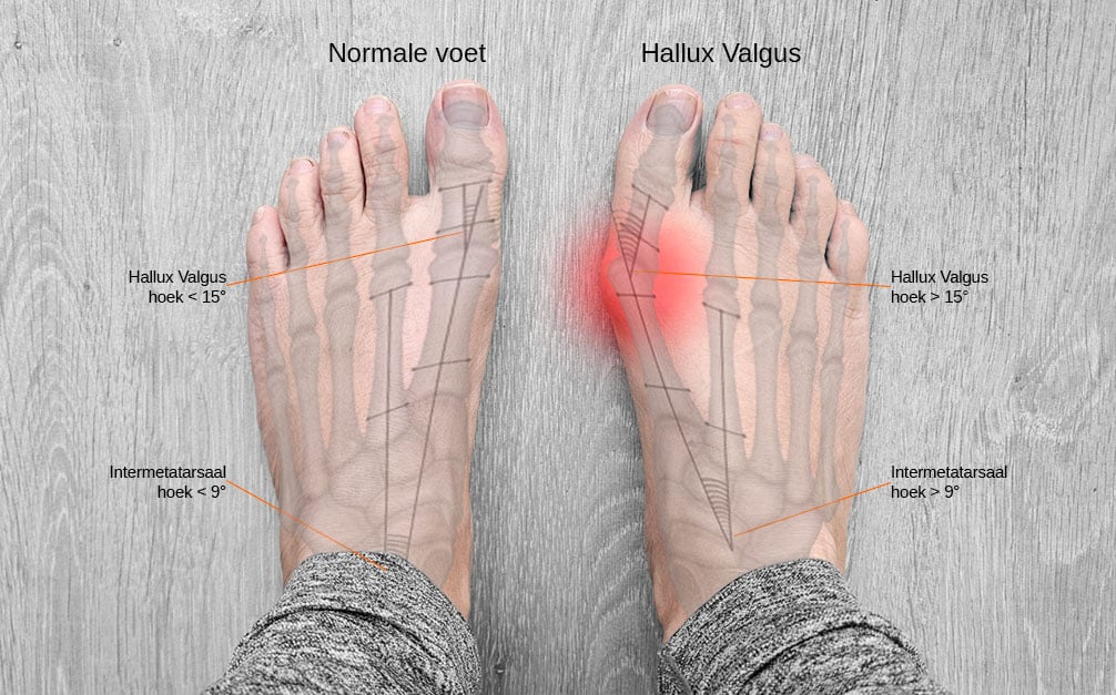 Afbeelding van voeten met aanduiding van de plek waar Hallux Valgus ontstaat.