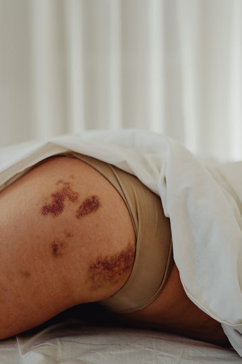 синяки на бедрах