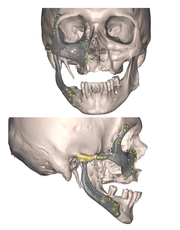 Лицо военного восстановили с помощью титановых протезов. Фото: Первое ТМО Львова