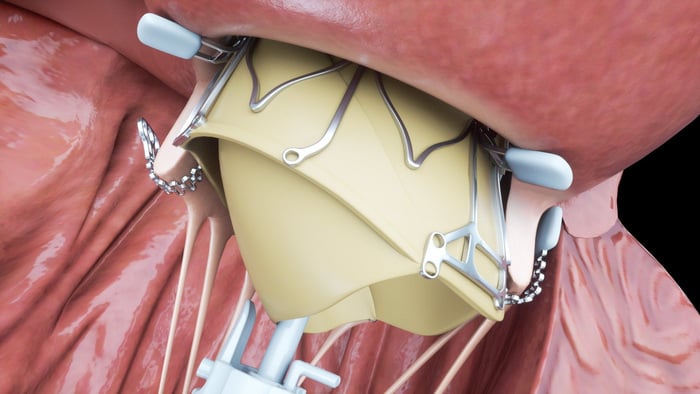 Искусственный клапан Epygon