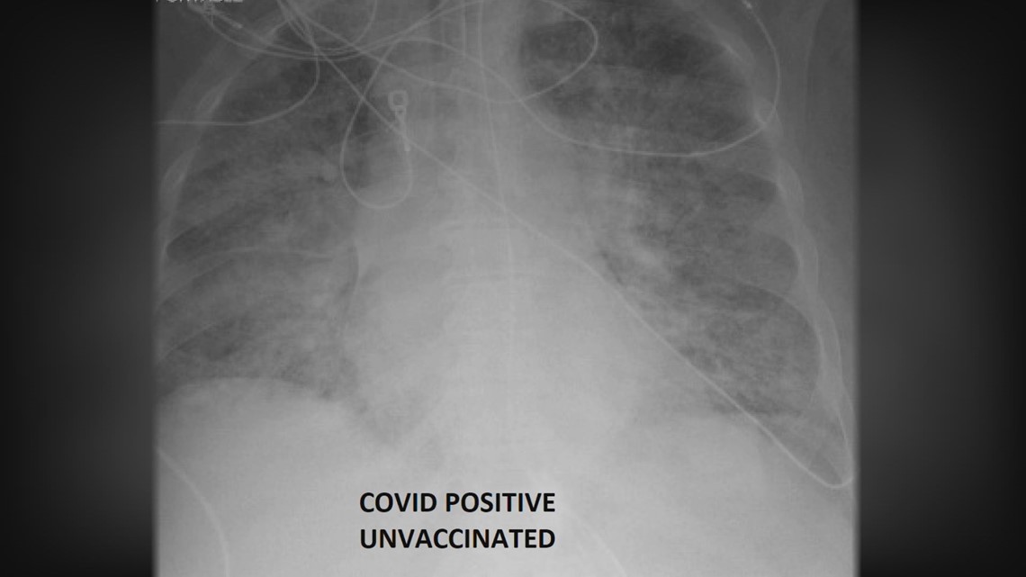рентгенівські знімки хворих на COVID-19