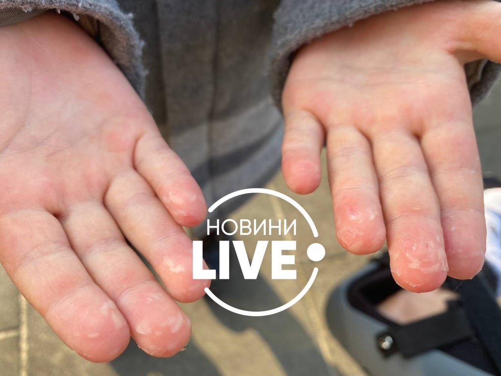 Дети в Киеве болеют на вирус Коксаки