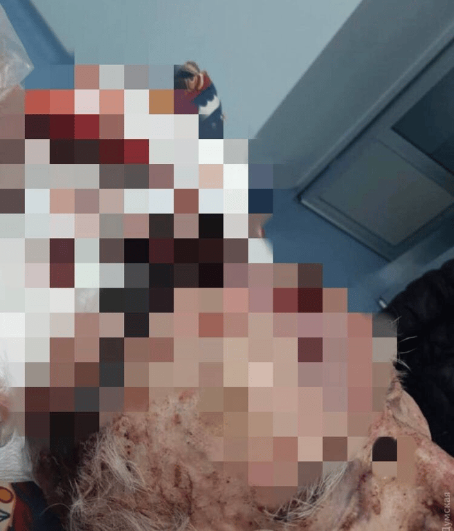 В Одесі помер пенсіонер із COVID-19, якого виписали з травмою голови