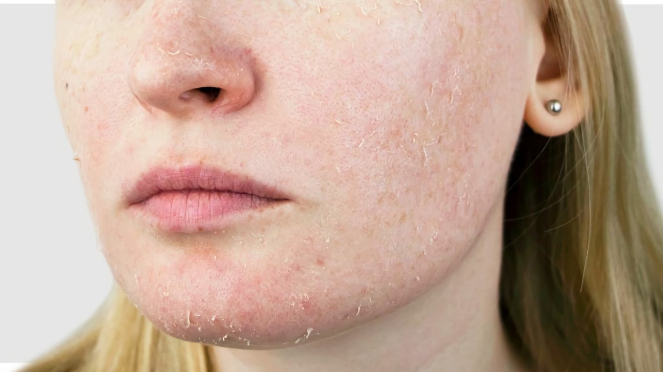 Какие симптомы сухости кожи наиболее распространены