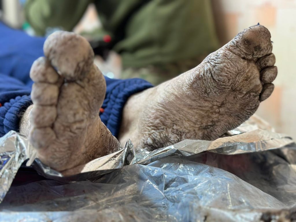 Що таке траншейна стопа