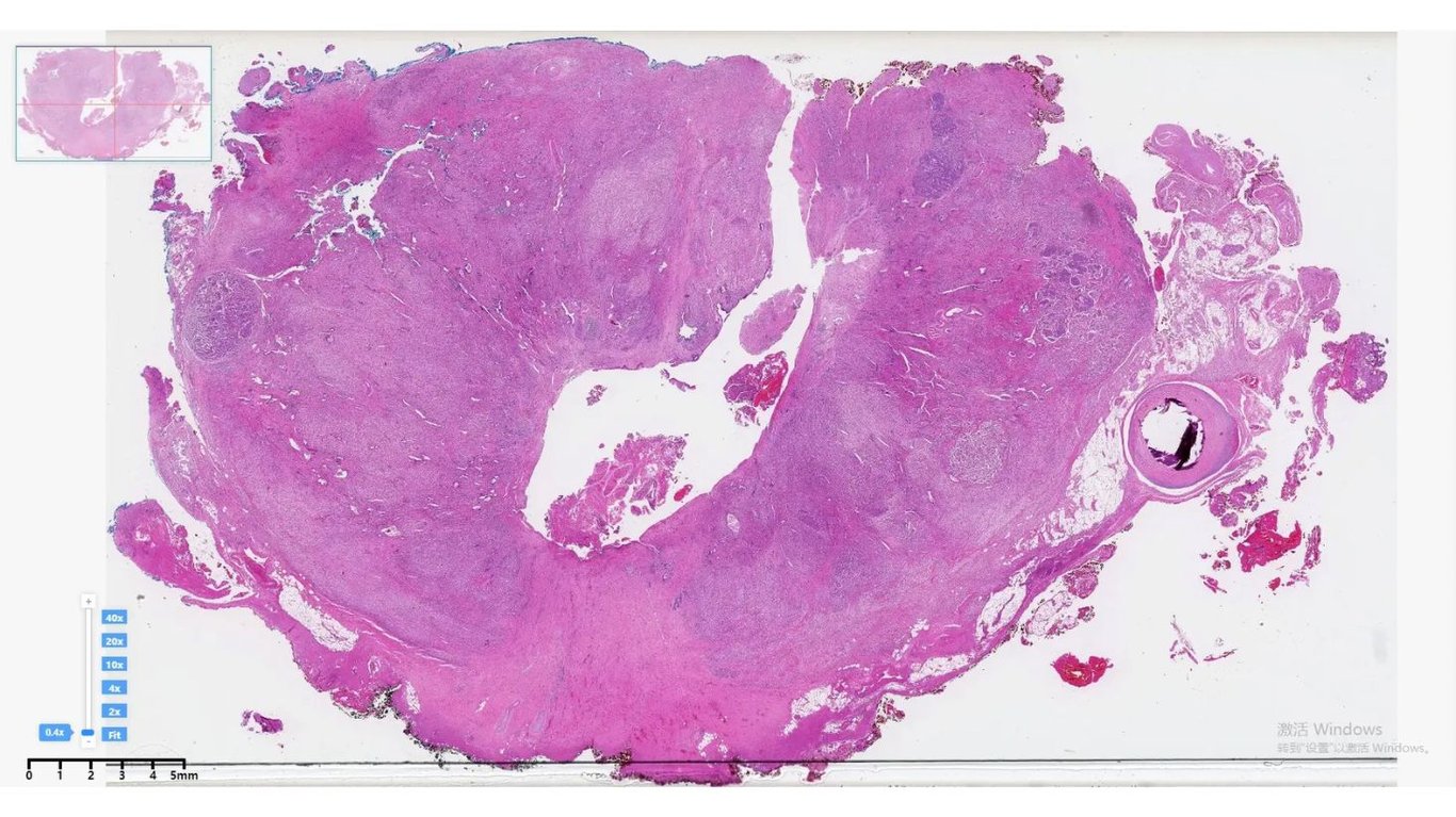 диагностика рака