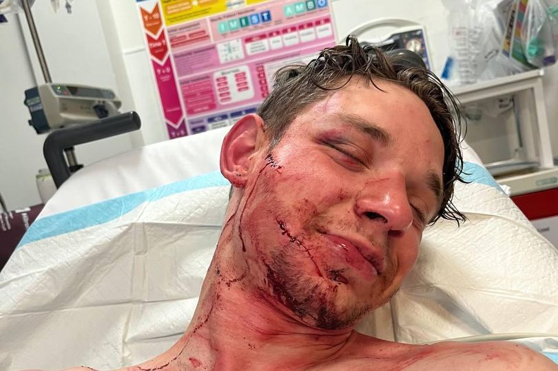 Українському актору в Дубліні порізали обличчя - фото 1