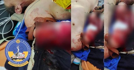 В Одесі чоловіку відірвало руку