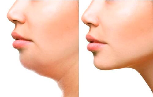 подвійне підборіддя 2