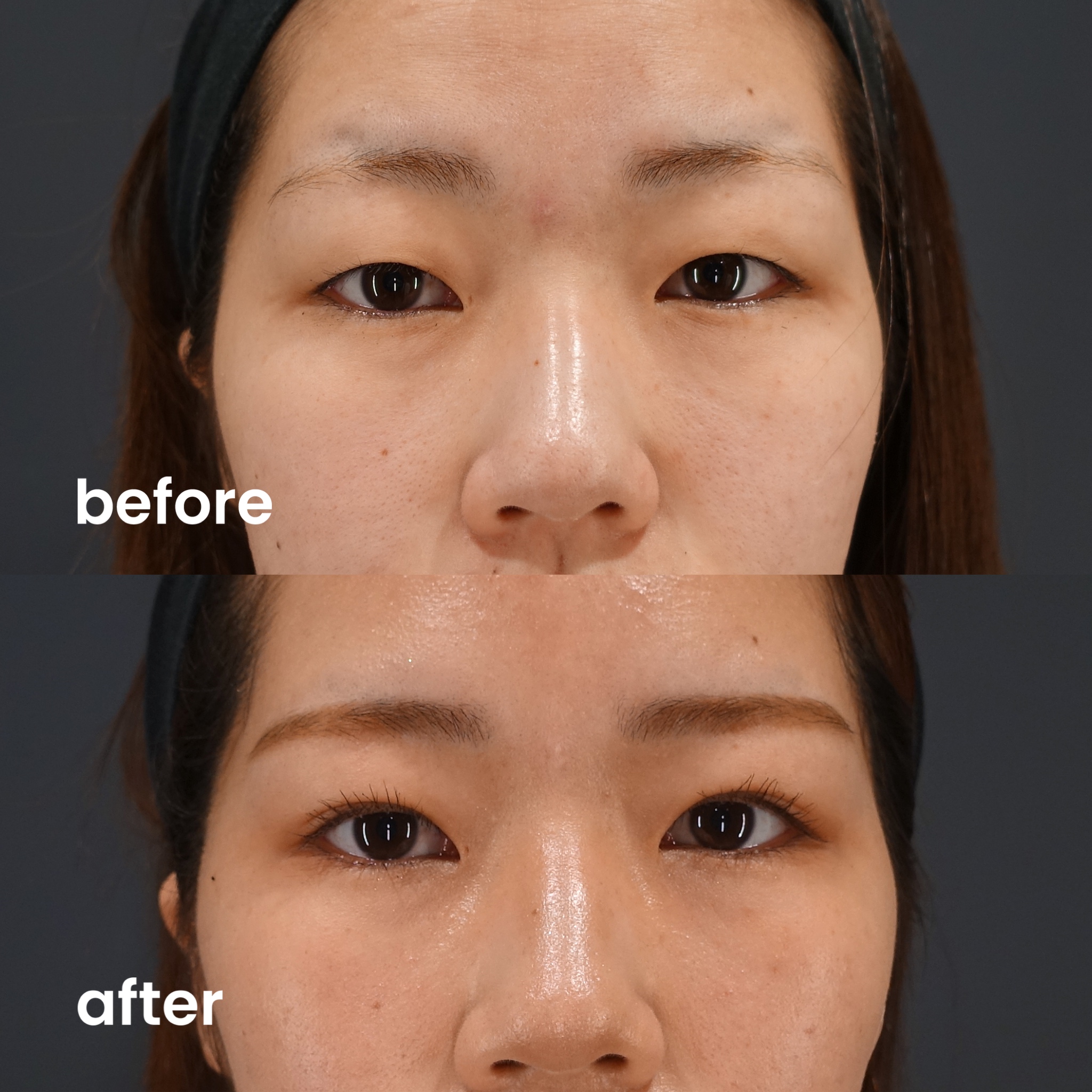 Double Eyelid Surgery in Japan: A Cultural and Aesthetic Phenomenon