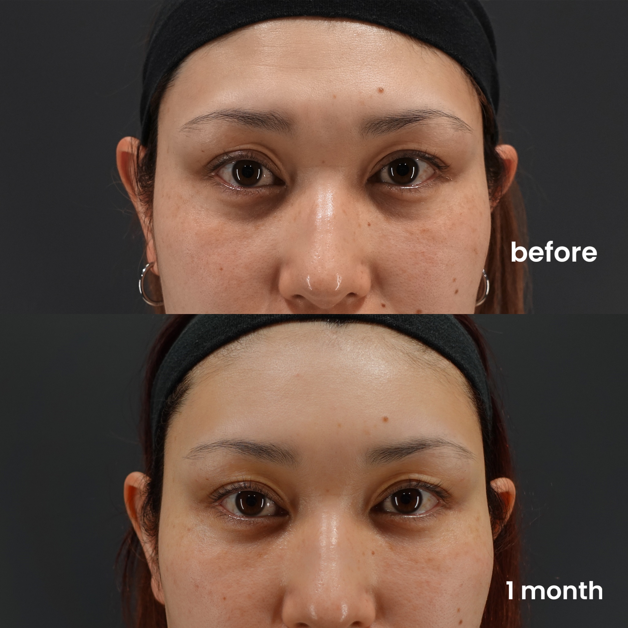 Understanding Dark Circles: Causes and Insights