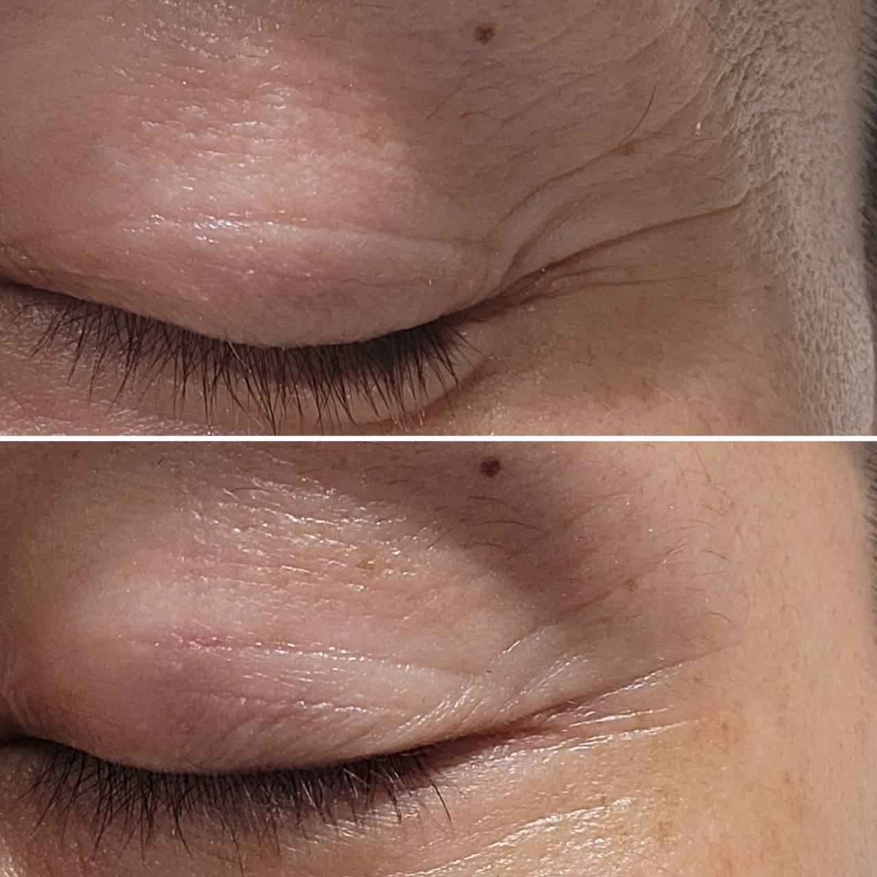 REJURAN, who is the 1st patient?