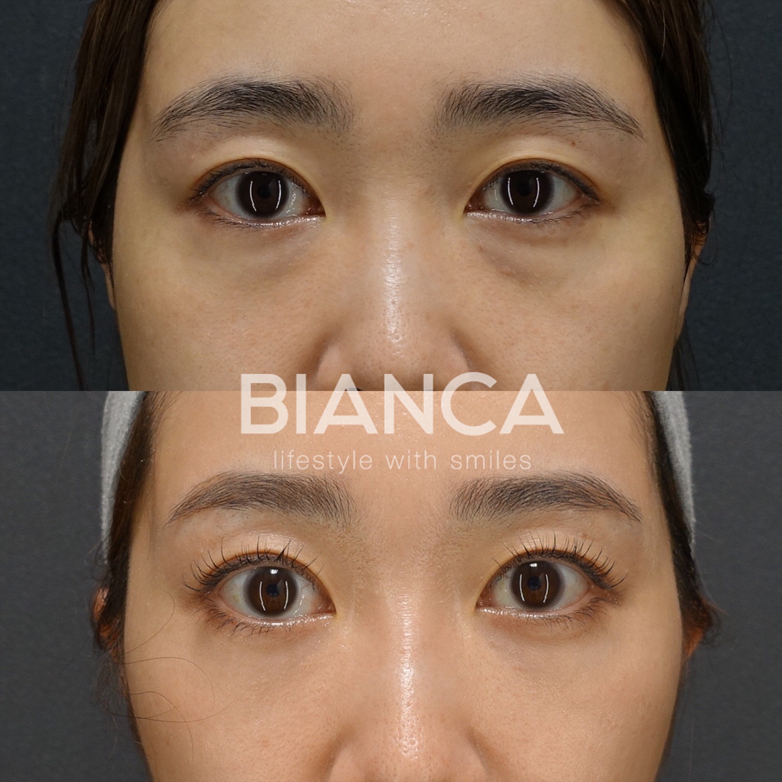 Transconjunctival Lower Lid Blepharoplasty; why Not Fat Removal?