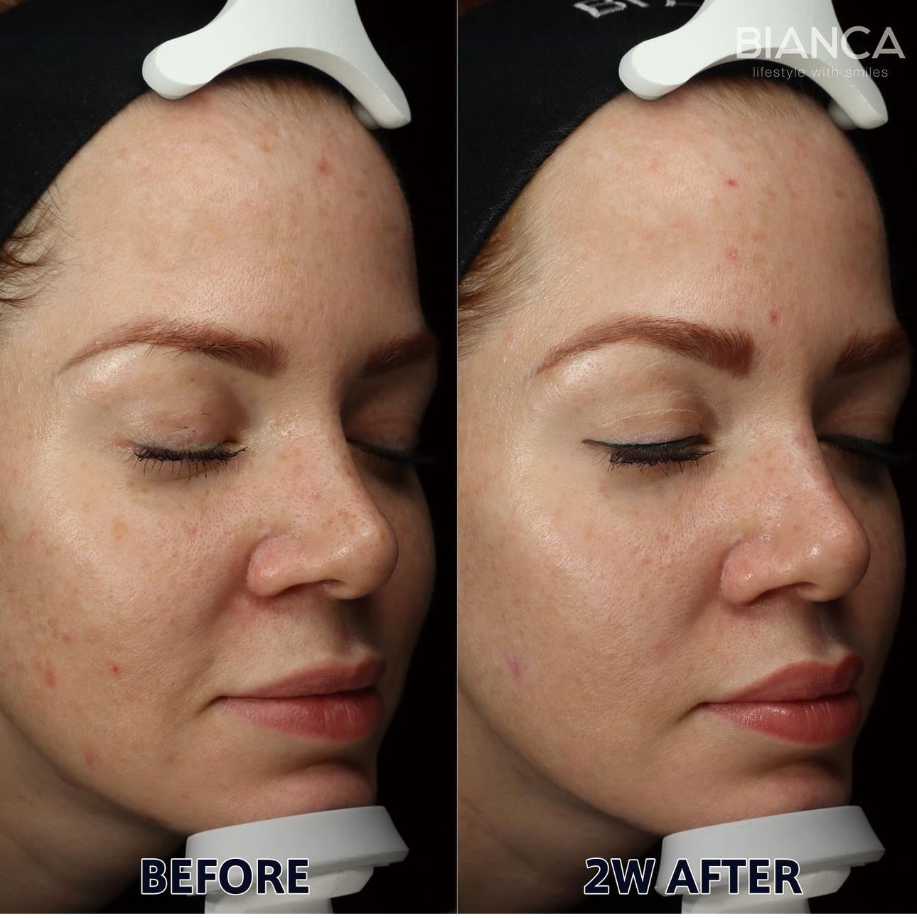 Freckle Treatment with Pico Laser!