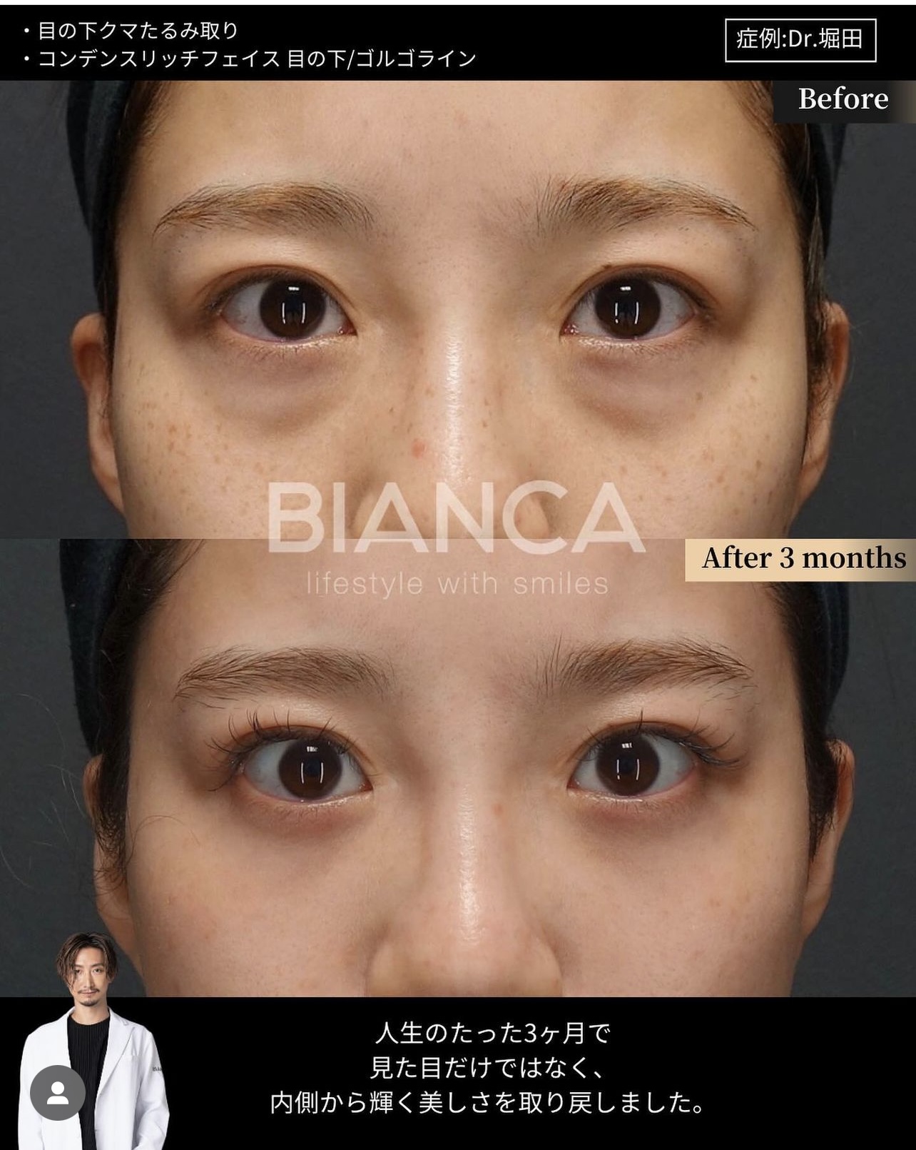 Dark circles under eyes; what kind do you have?