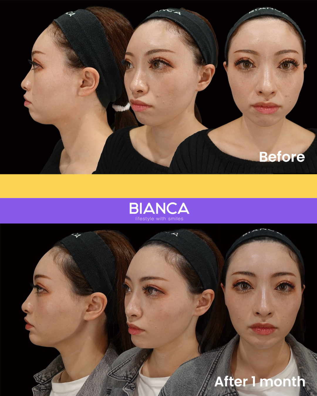 The all you should know about filler treatment.