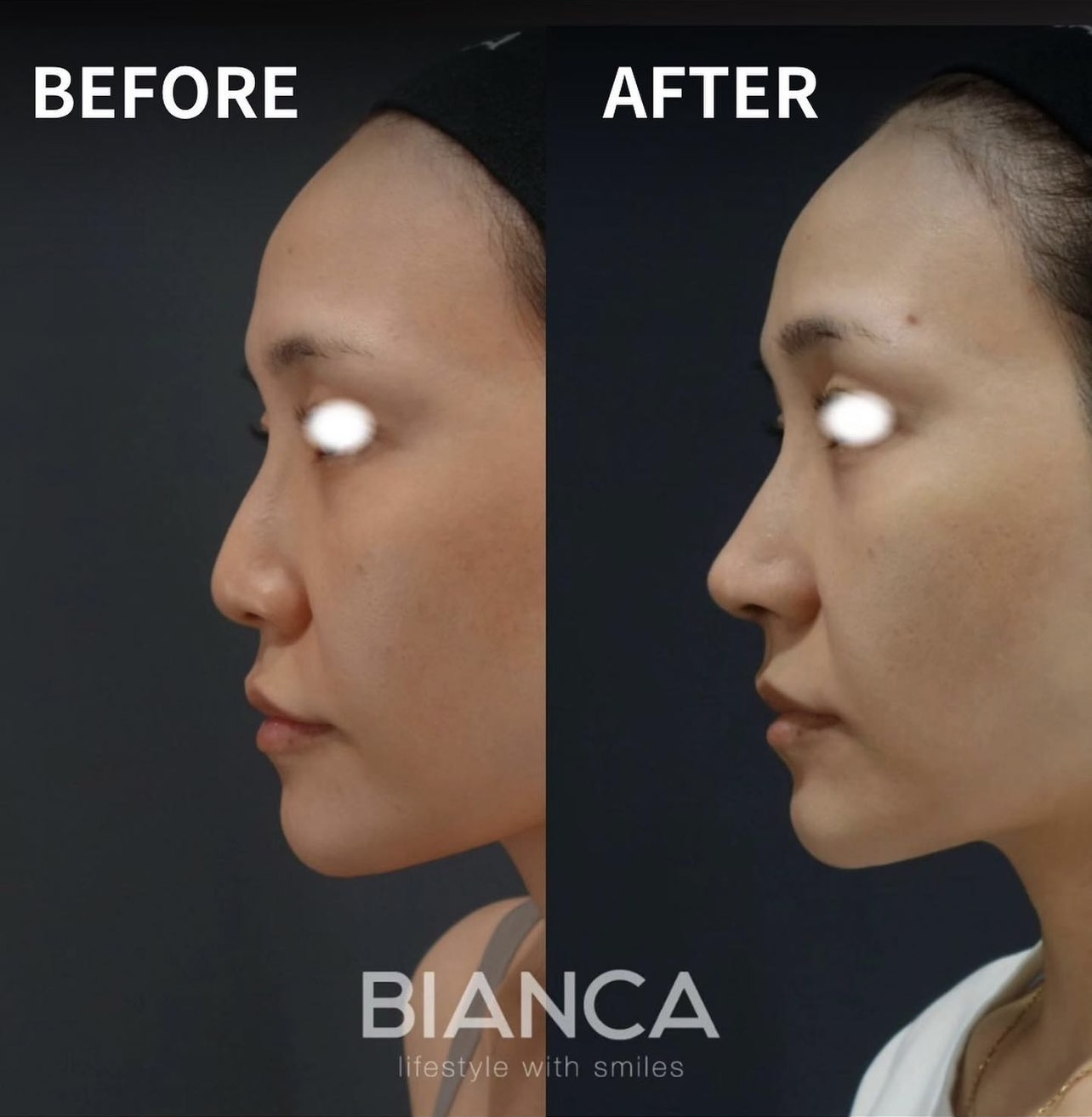 Preservation Rhinoplasty