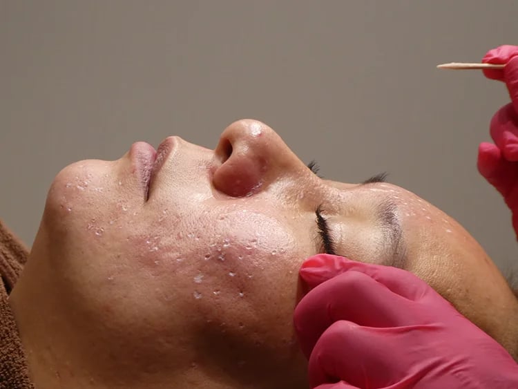 TCA CROSS Banish your acne scars.